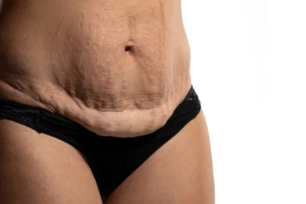 Lost the Weight but Not the Loose Skin? 1 image of womans stomach after weight loss showing loose skin Birchfield